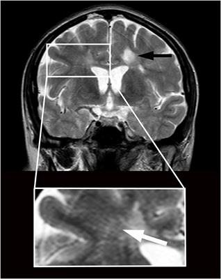 Case report: A multiple sclerosis patient with imaging features of glymphatic failure benefitted from CSF flow shunting